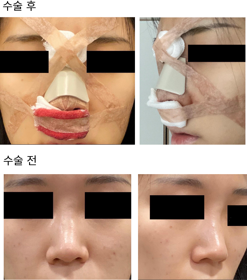 수술후기이미지