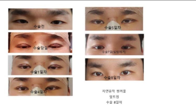 수술후기이미지