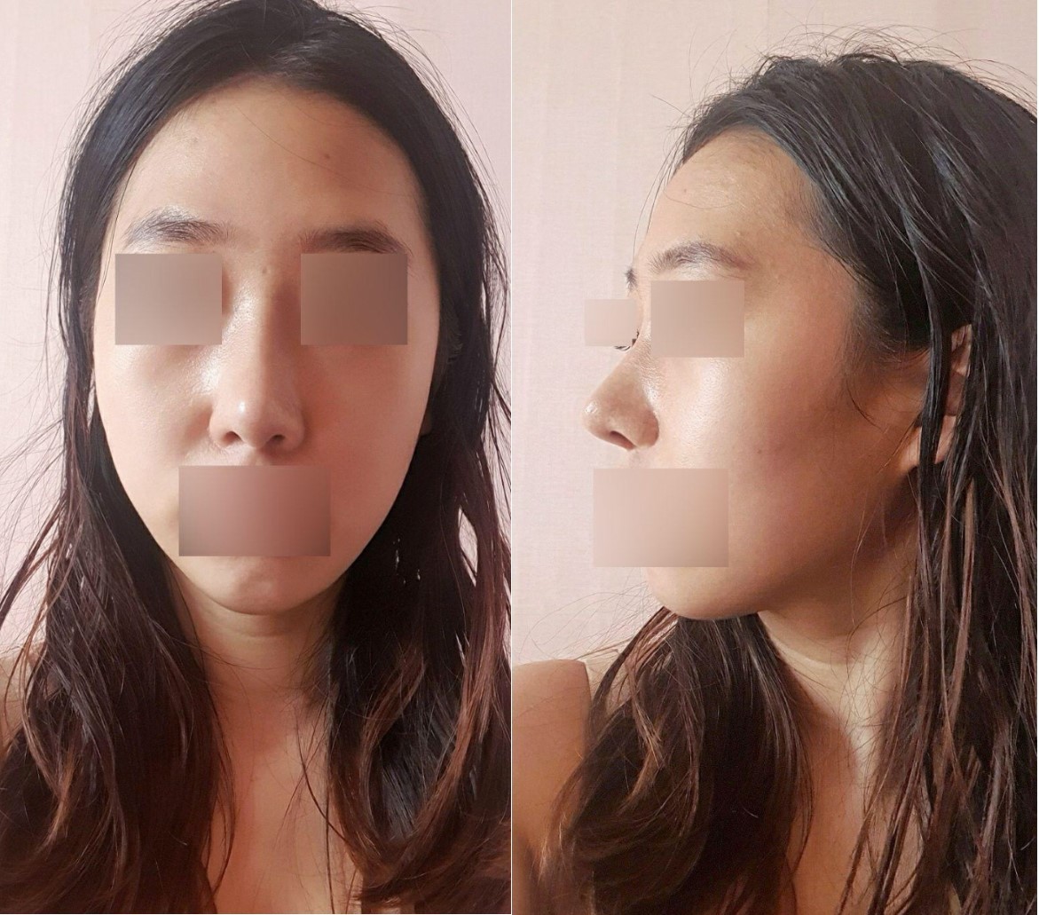 수술후기이미지