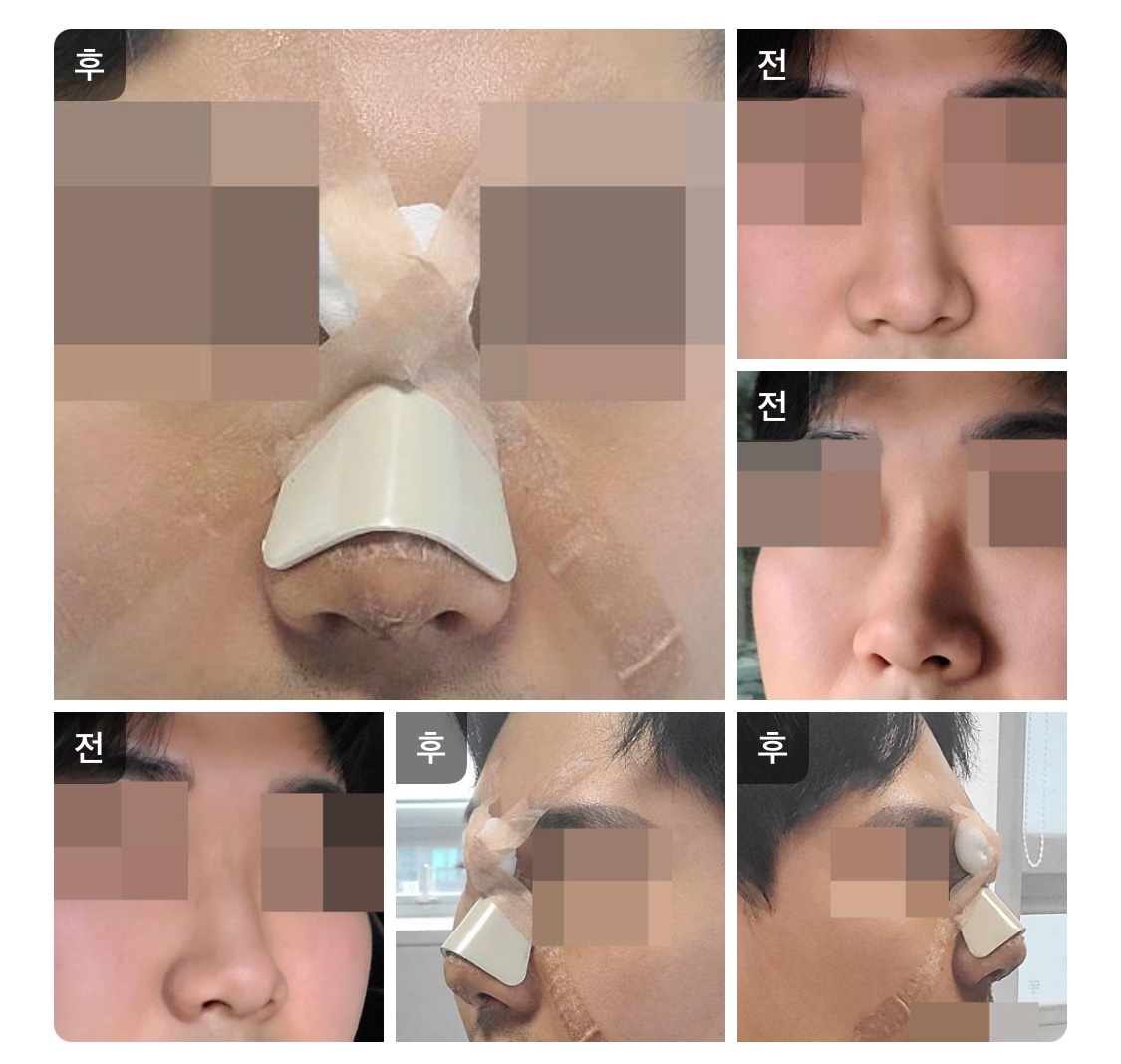 수술후기이미지