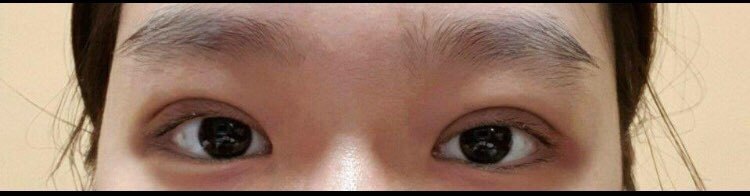 수술후기이미지