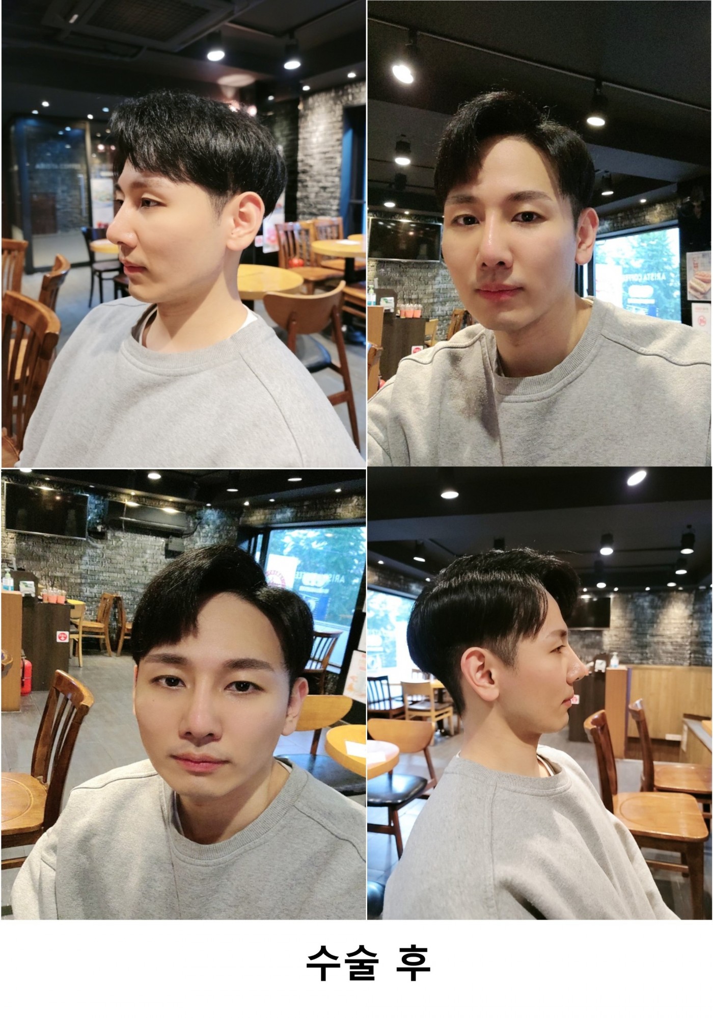 수술후기이미지