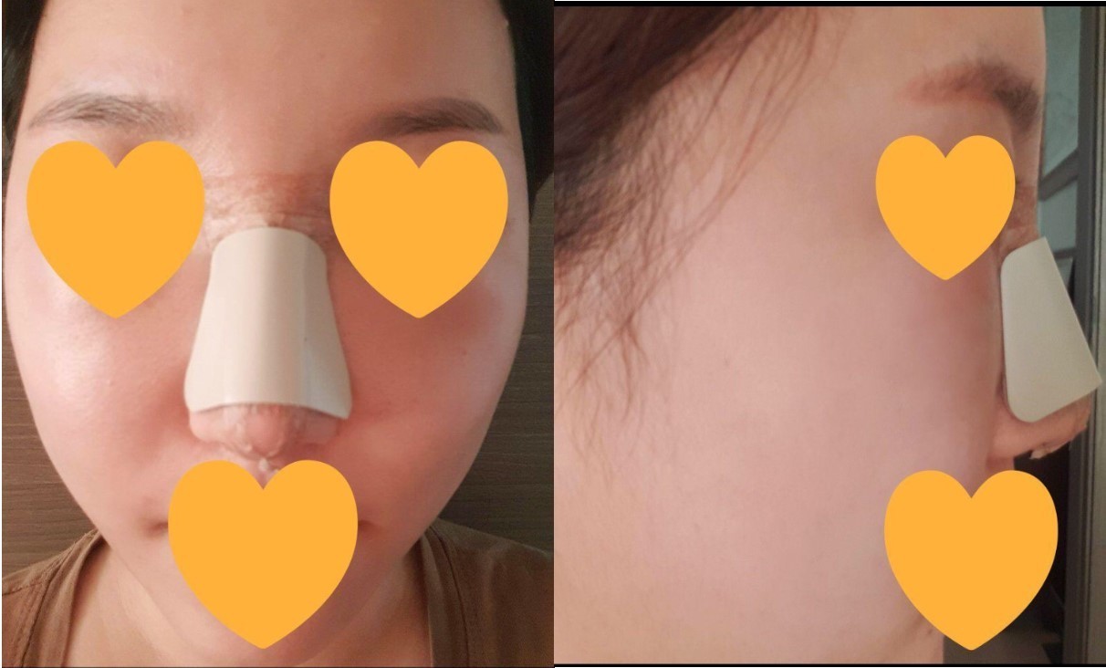 수술후기이미지