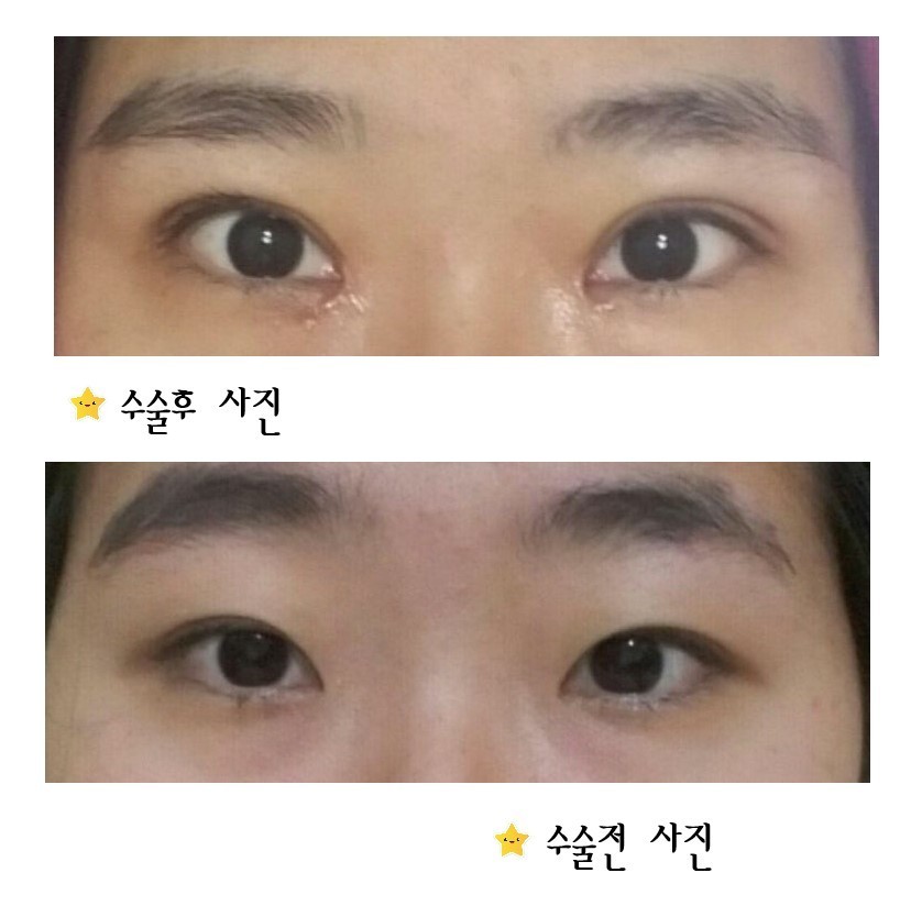 수술후기이미지