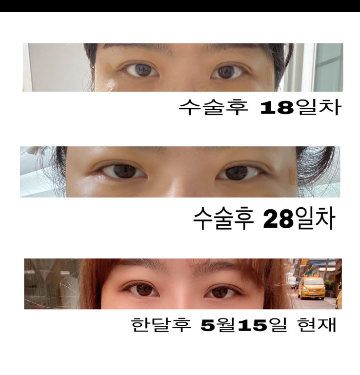 수술후기이미지