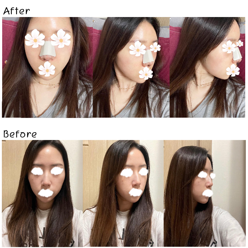 수술후기이미지