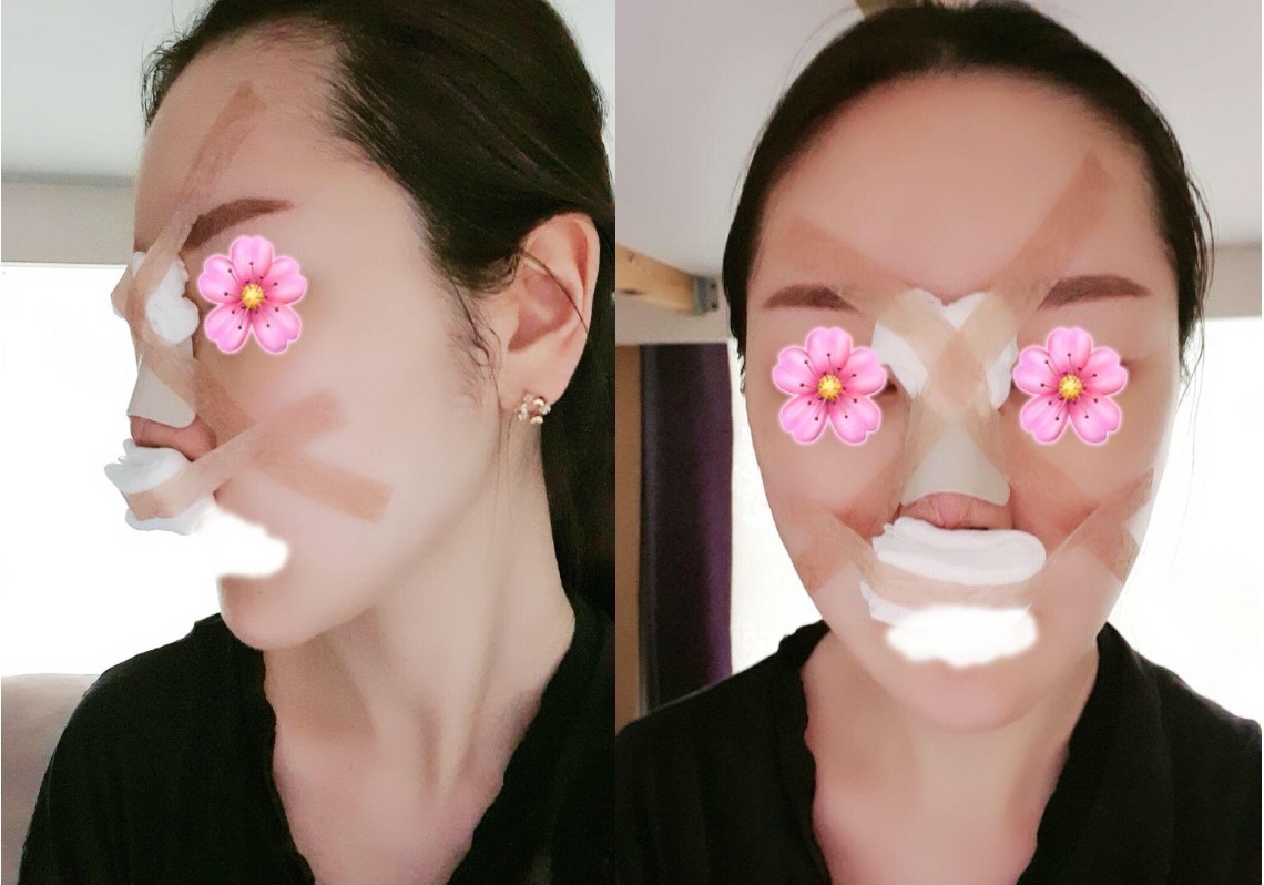 수술후기이미지