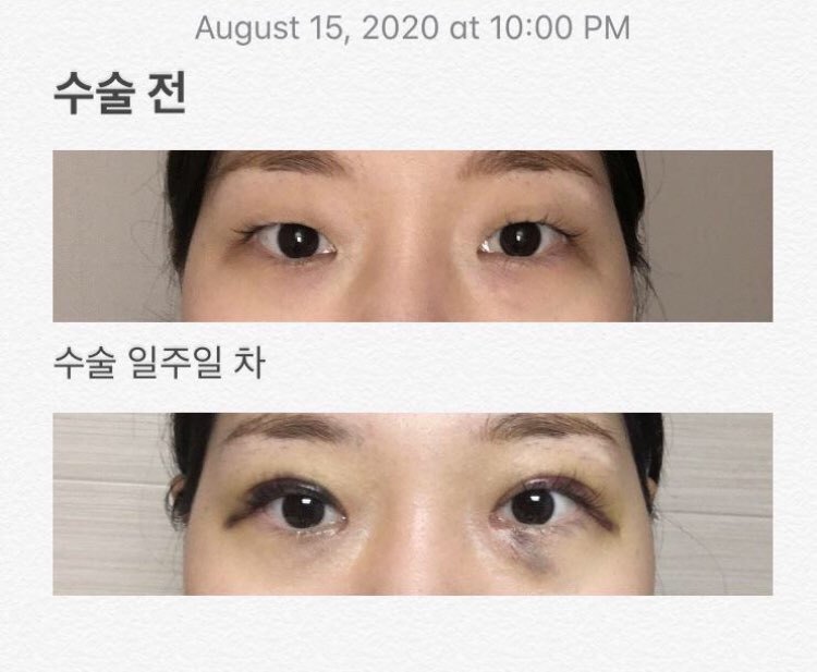 수술후기이미지