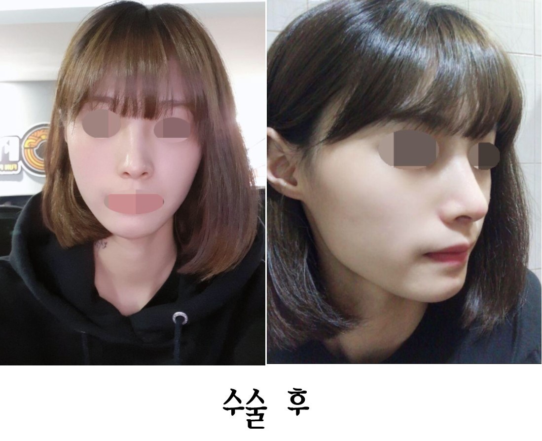 코수술 두달반 됐어요옹