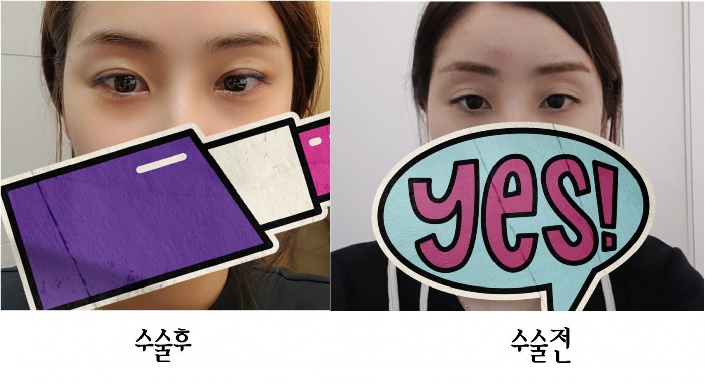 수술후기이미지