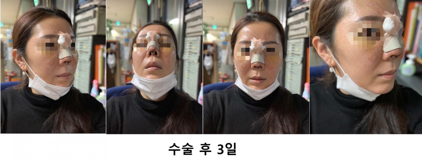 수술후기이미지