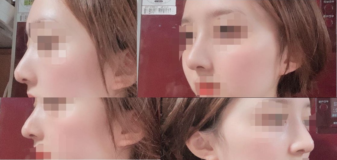 수술후기이미지