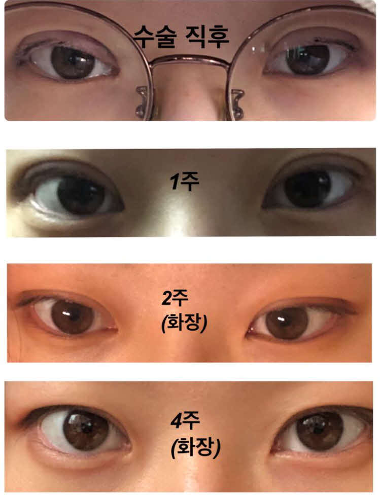 수술후기이미지