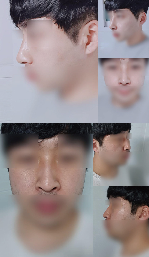 수술후기이미지