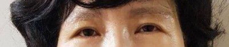 수술후기이미지