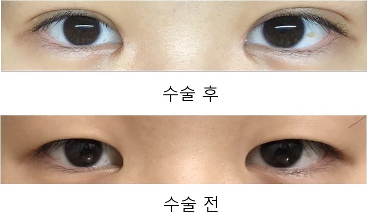 수술후기이미지