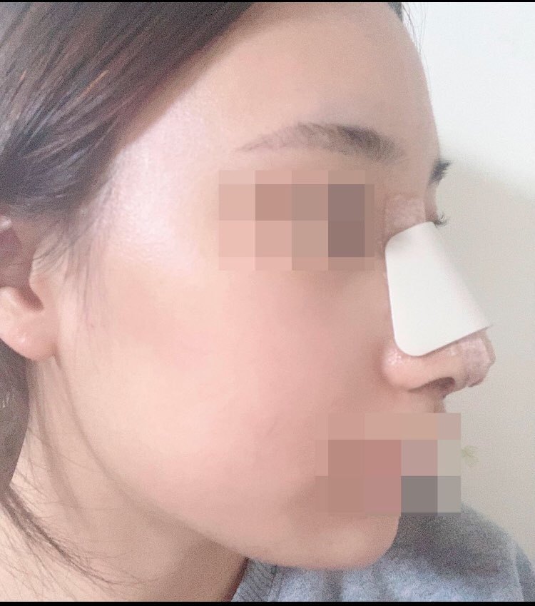 수술후기이미지