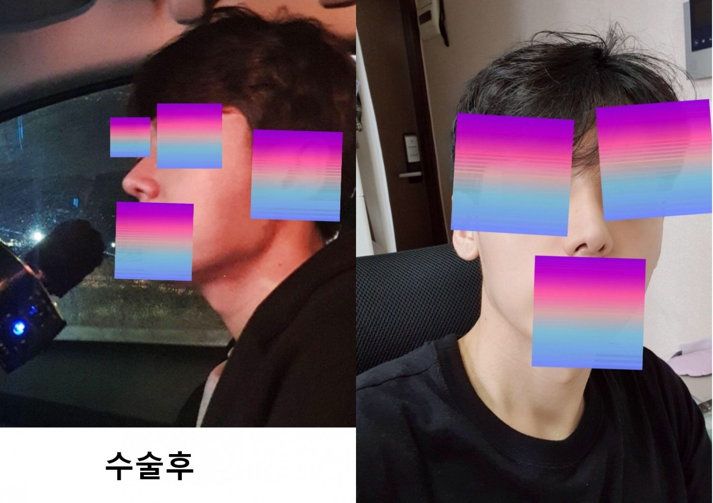 수술후기이미지