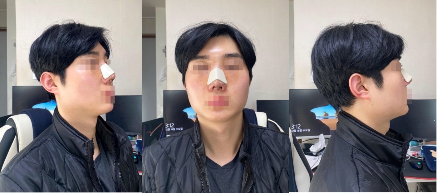 수술후기이미지