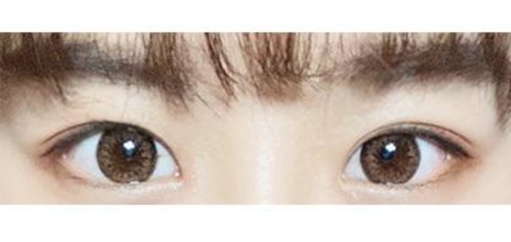 눈매교정, 눈, 앞트임