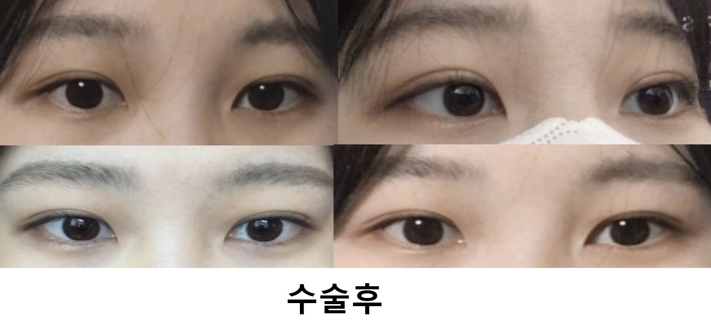 수술후기이미지