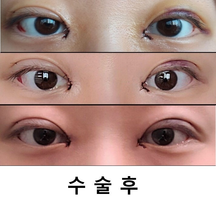 수술후기이미지