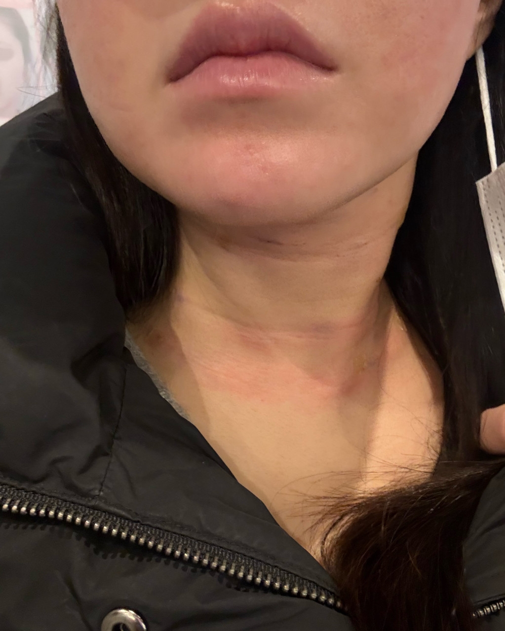 수술후기이미지