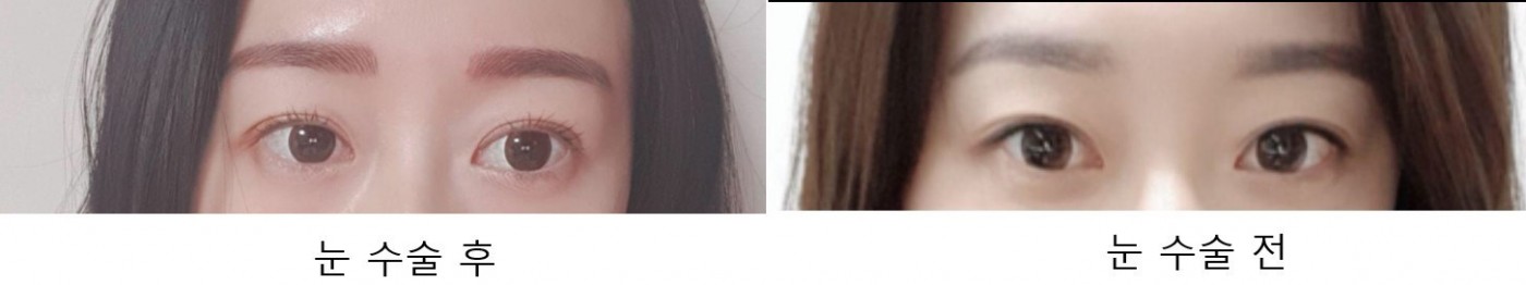 수술후기이미지