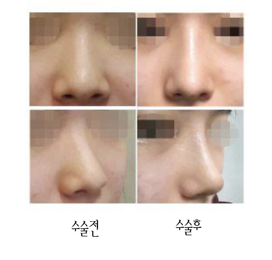 수술후기이미지