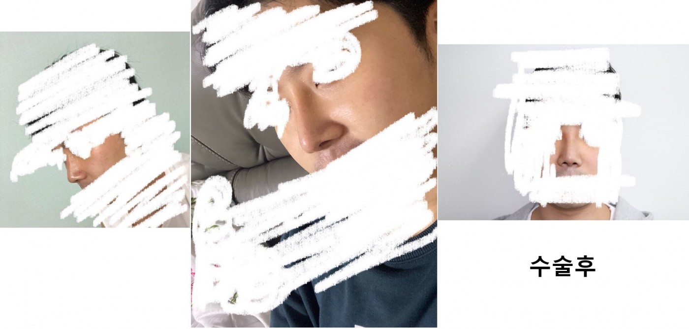 수술후기이미지