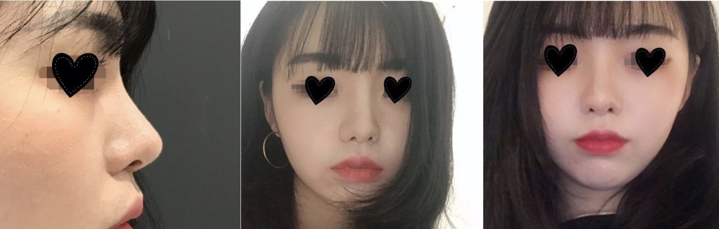 수술후기이미지