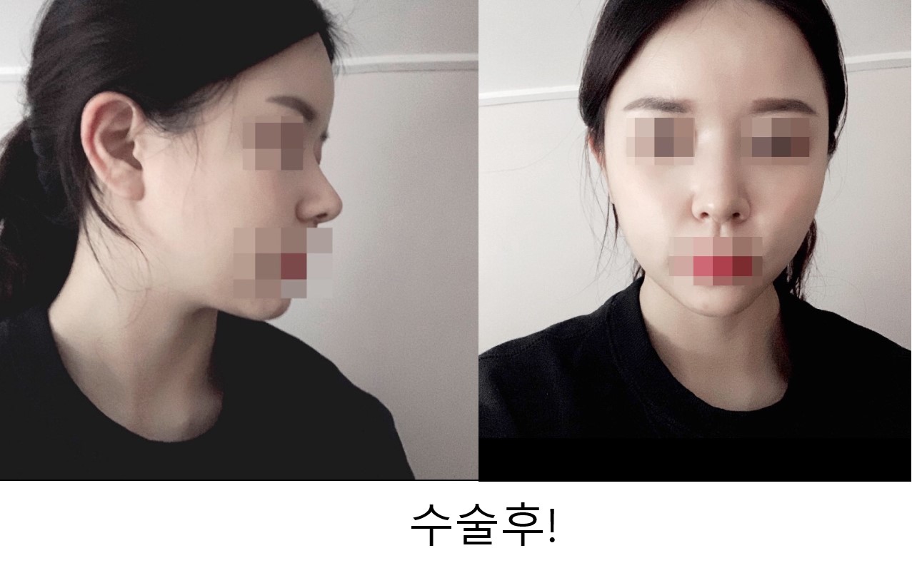 수술후기이미지