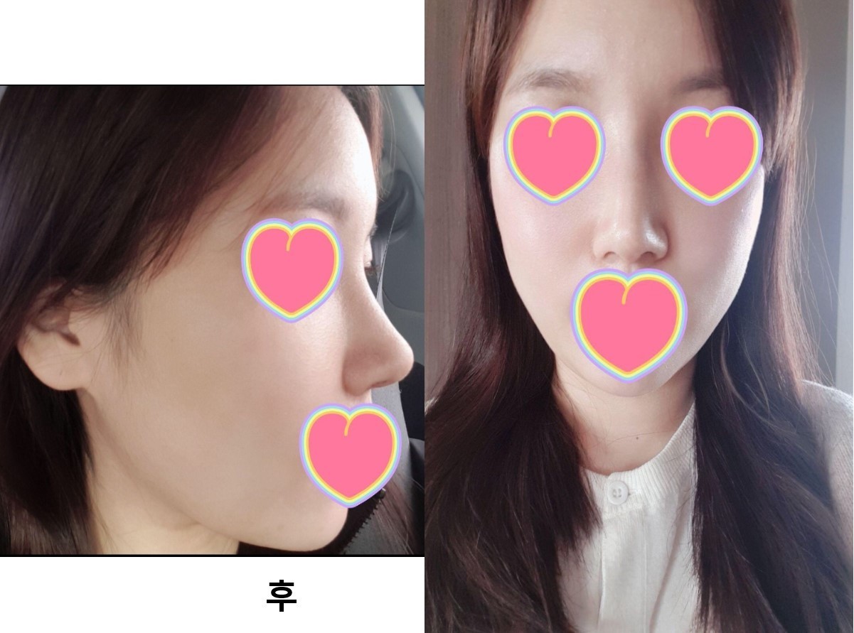 수술후기이미지