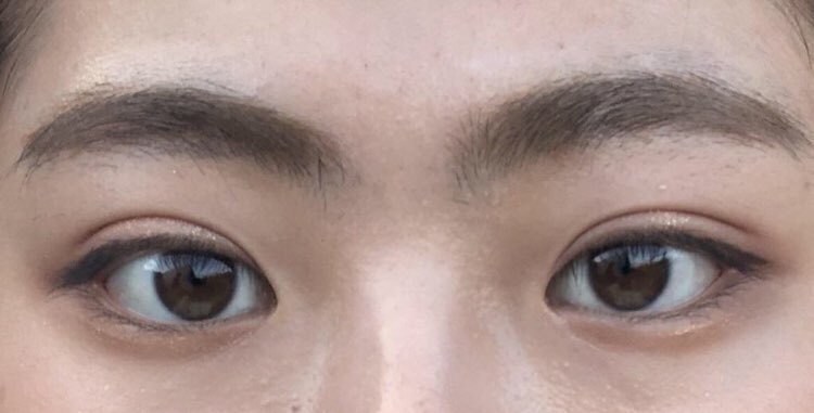 수술후기이미지