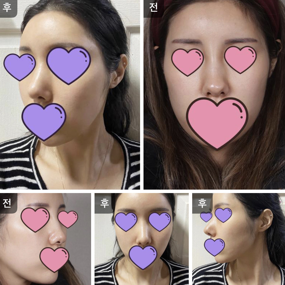 수술후기이미지