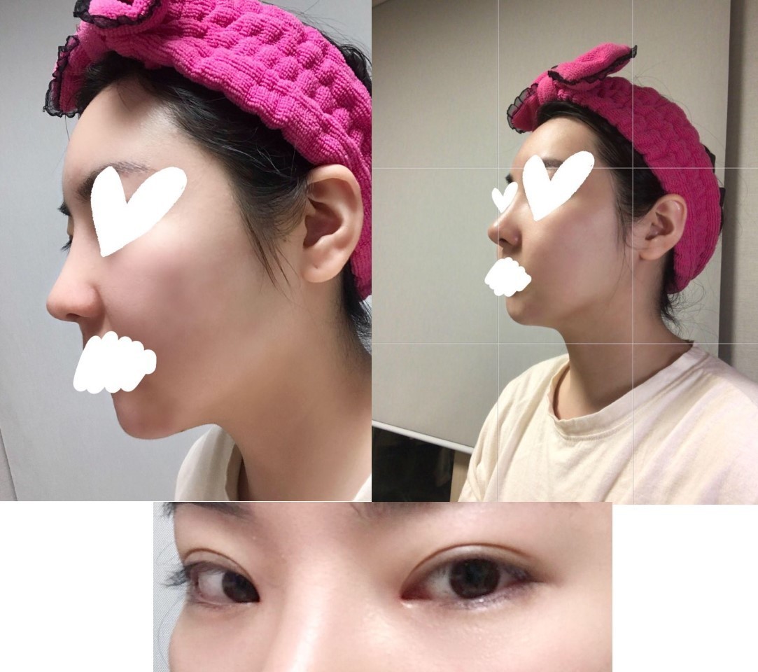 수술후기이미지