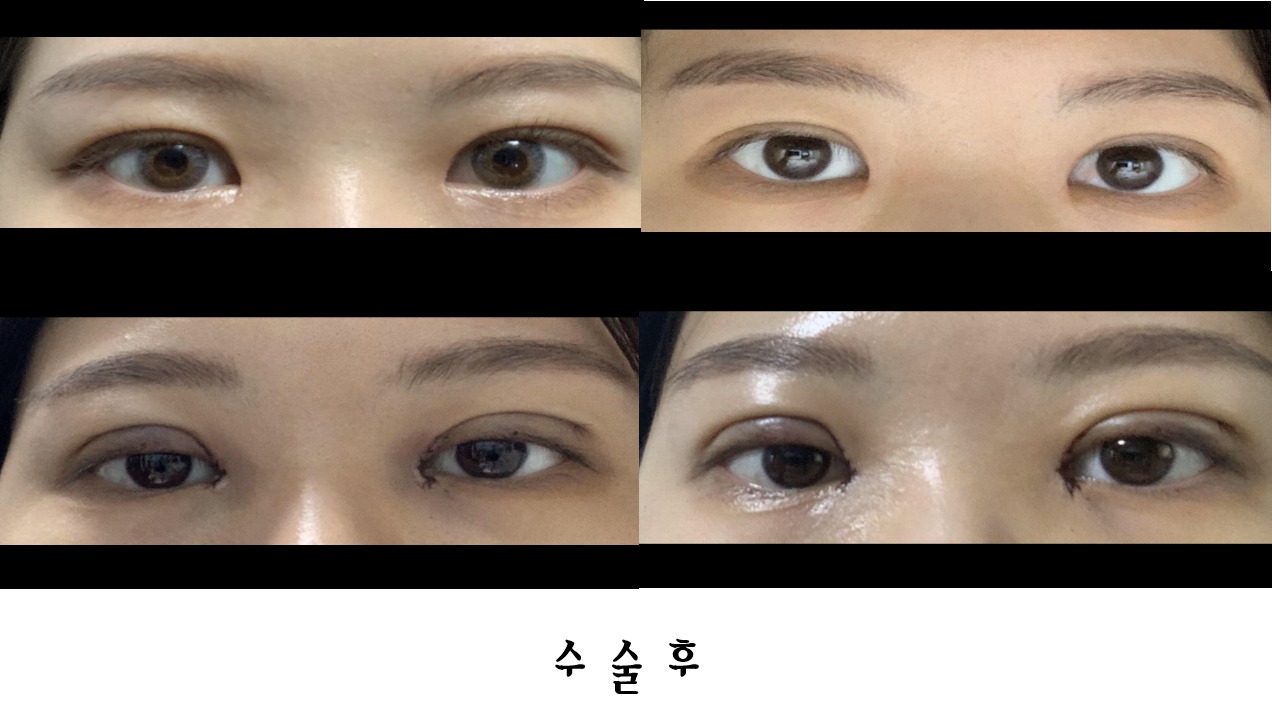 수술후기이미지