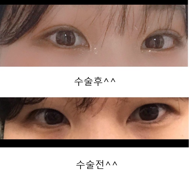 수술후기이미지