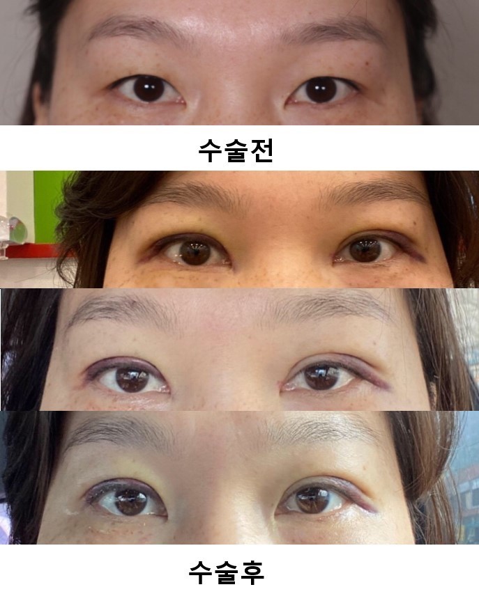 수술후기이미지