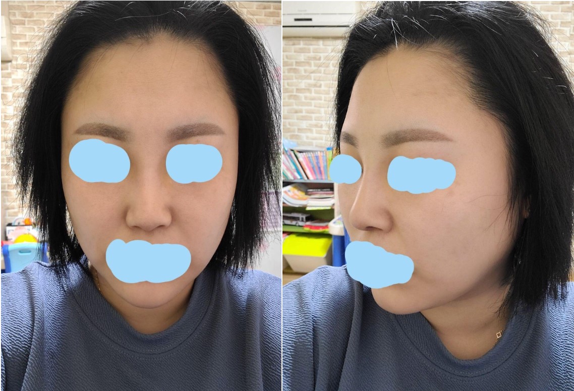 수술후기이미지