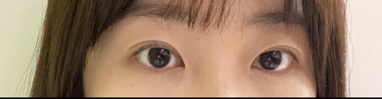 수술후기이미지