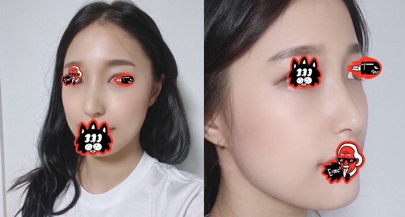 수술후기이미지