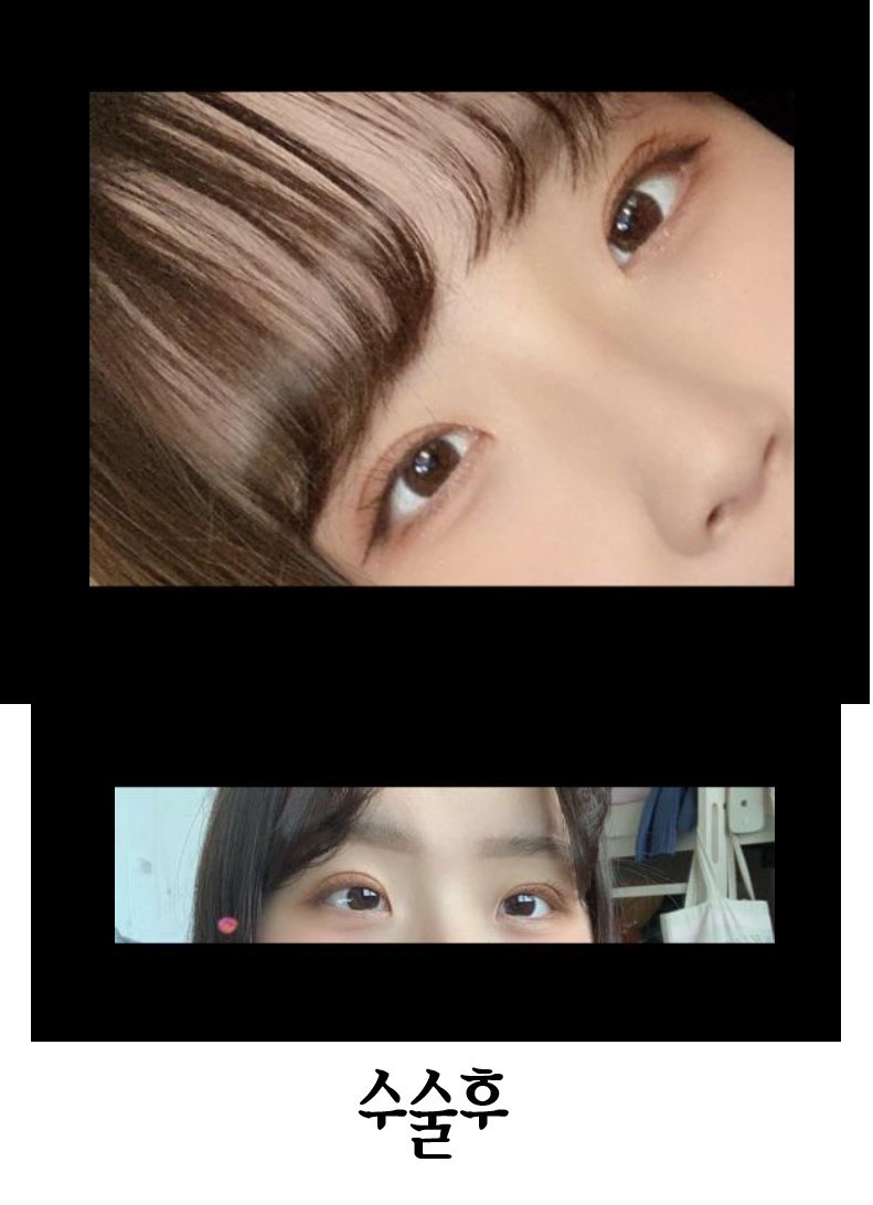 수술후기이미지