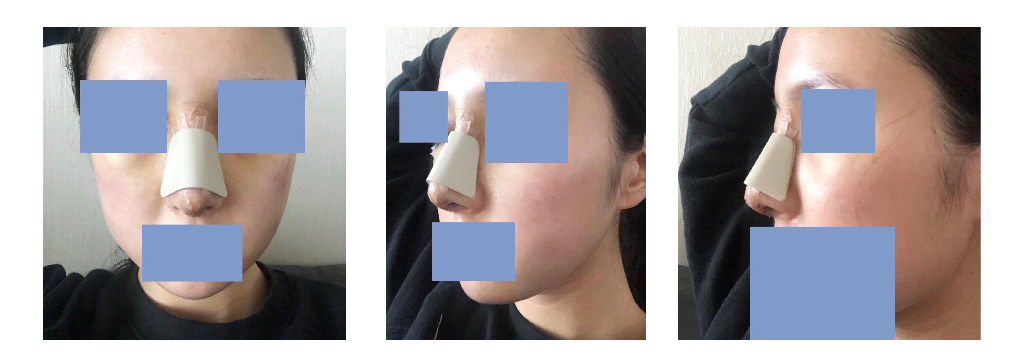 수술후기이미지