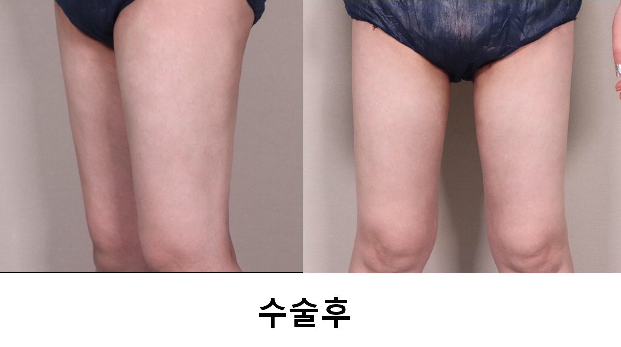 허벅지 지방흡입 3개월