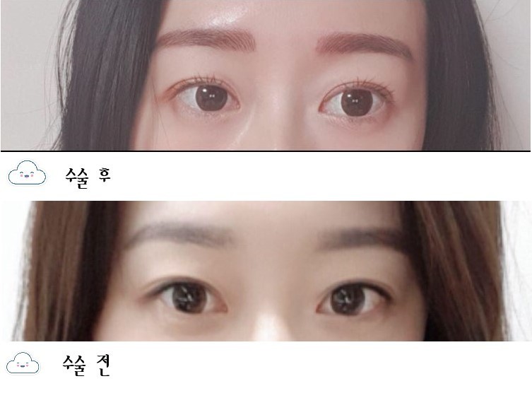 수술후기이미지